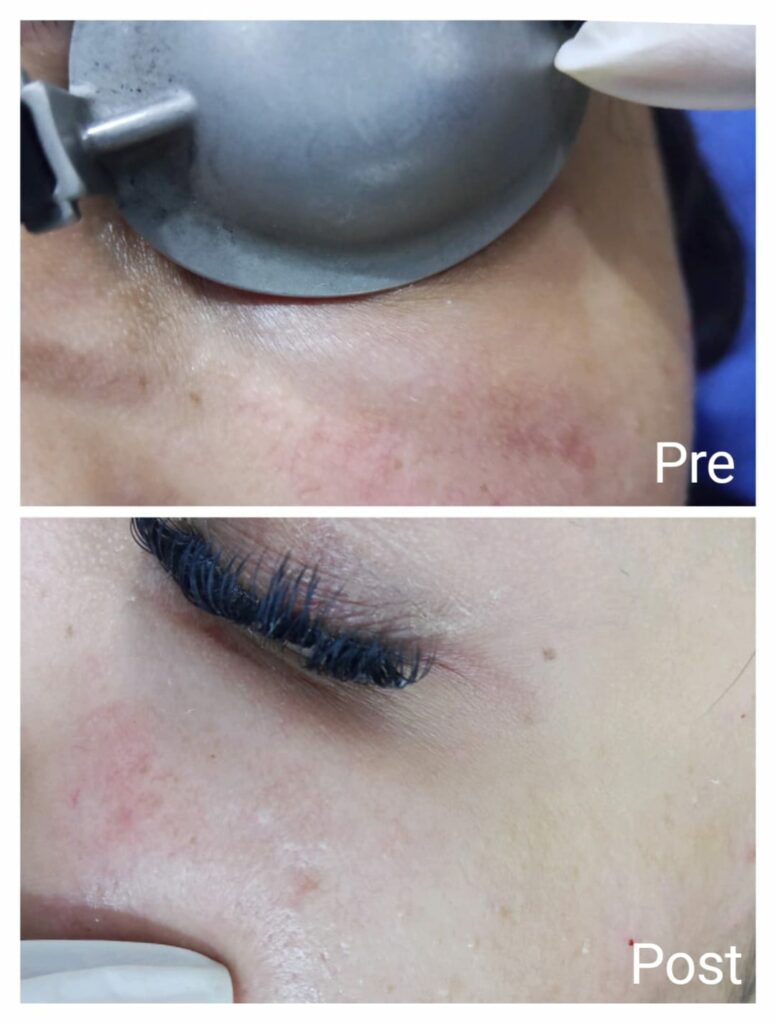 جلسة واحده للهالات السوداء تحت العين بالليزر